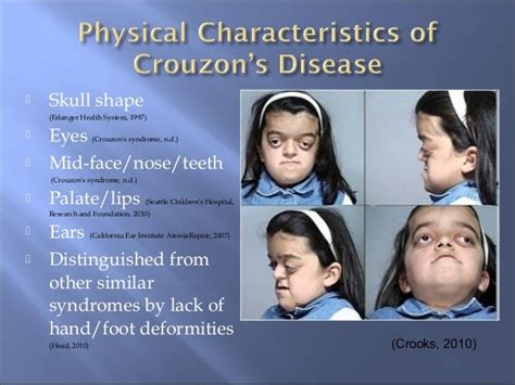 Crouzon’s Syndrome