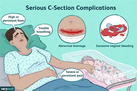 How to Pee After C Section?