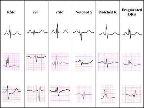 References in Fragmented QRS on a 12-lead ECG: A predictor of mortality ...