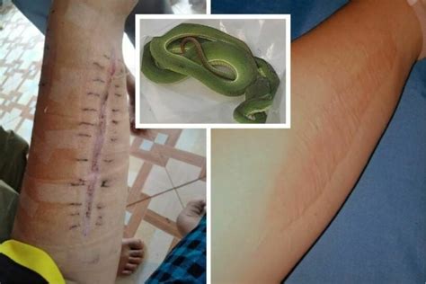 Woman almost loses arm after green snake pit viper bite | Thaiger