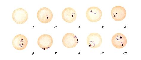 Malaria - Plasmodium falciparum: Ring Stage Parasites