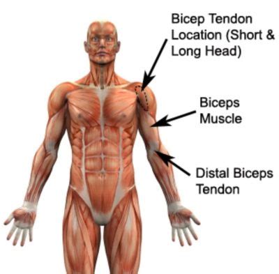 Biceps Rupture - Ruptured Biceps - PhysioAdvisor