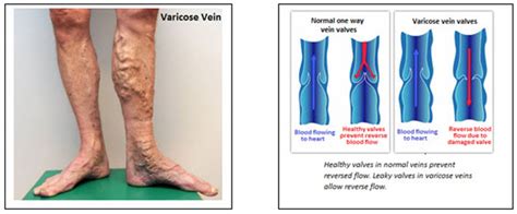 Varicose Veins, Laser Haemorrhoids, Vascular Surgery Treatment, Kuala Lumpur Malaysia. Dato Dr T ...