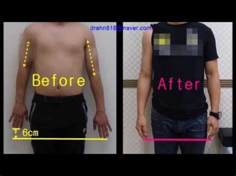 Free arm motion after 6cm arm lengthening surgery - YouTube