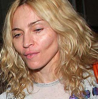 Madonna's Cheek Implants | Lam Facial Plastic Surgery Center