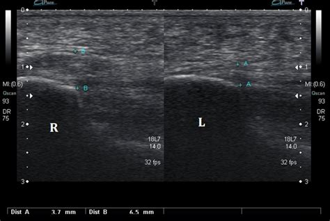 Ultrasound Images of Plantar Fasciitis - Ankle, Foot and Orthotic Centre