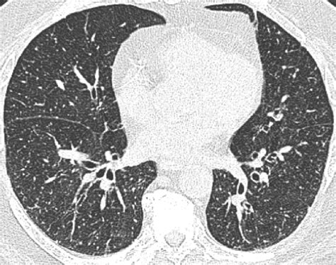 Complications of Intravesical BCG Immunotherapy for Bladder Cancer | RadioGraphics