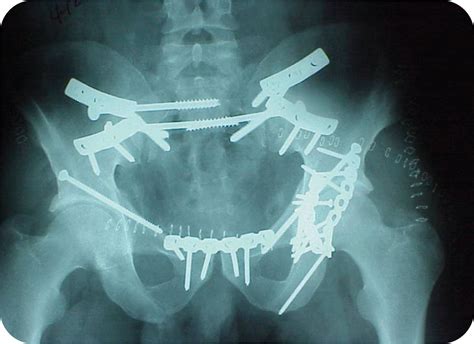 Chattanooga Orthopaedic Trauma Surgery Fellowship | Orthopaedic Surgery | College of Medicine ...