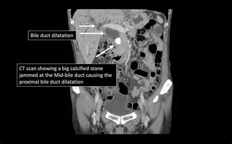 Bile Duct Stones Removal In Singapore | LS Lee Surgery Clinic