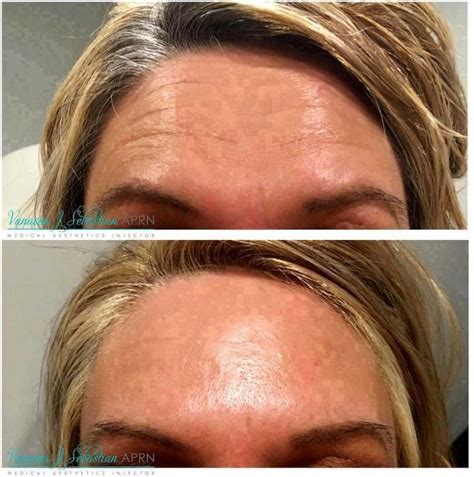 Botox Before And After Pics Forehead (5) » Facelift: Info, Prices ...