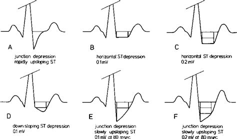 Figure 1 from Clinical Significance of Upsloping ST Segments in Exercise Electrocardiography ...