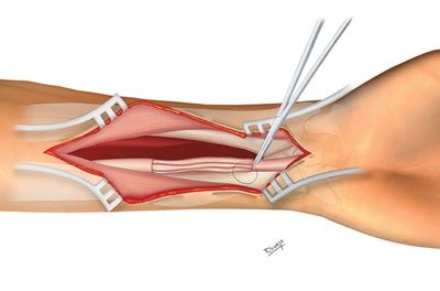 Peripheral Nerve Surgery | University of Miami Health System