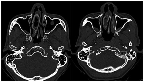 SciELO - Brasil - Anatomical Variations of the Middle Turbinate Concha Bullosa and its ...