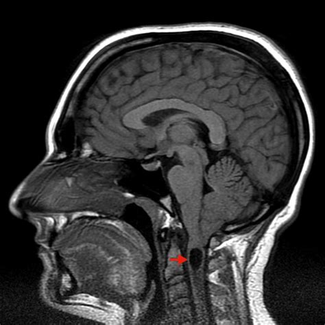 Chiari-Malformation | Neurochirurgie Inselspital Bern