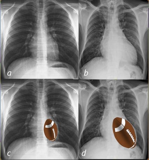 Left Ventricle – LV – CXR | Heart