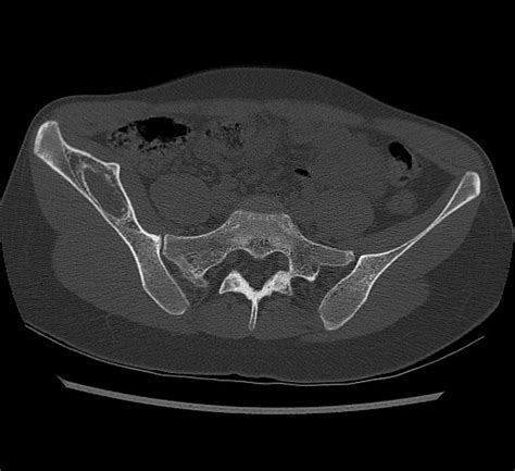 Subperiosteal hematoma of the iliac bone | Image | Radiopaedia.org