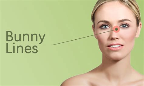 Bunny lines Treatment in Surat - Elegance Clinic