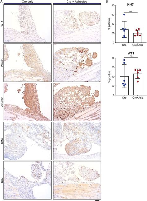 How To Interpret Breast Biopsy Results