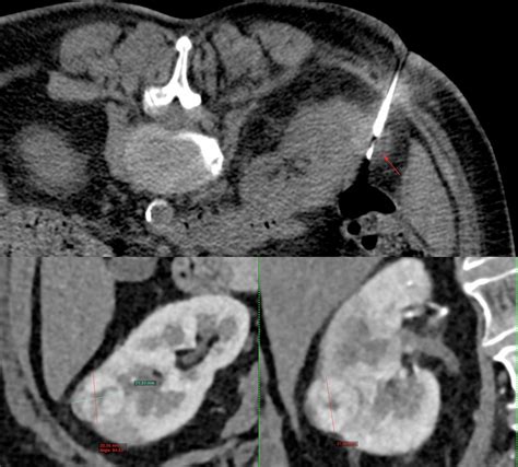 Case 20: 2.1 cm Renal Mass Biopsy