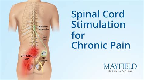 Spinal Cord Stimulation for Chronic Pain - YouTube