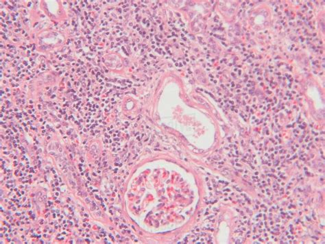 Histology micrograph of renal failure, showing interstitial nephritis in tissue of kidney with H ...