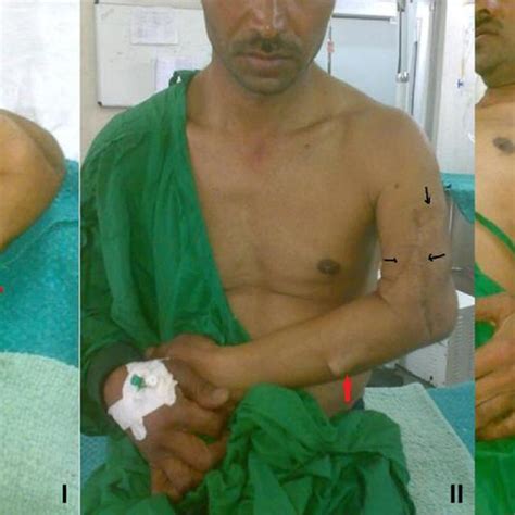 e (I) Anterior lacerated wound scar mark in a muscular arm and plate... | Download Scientific ...