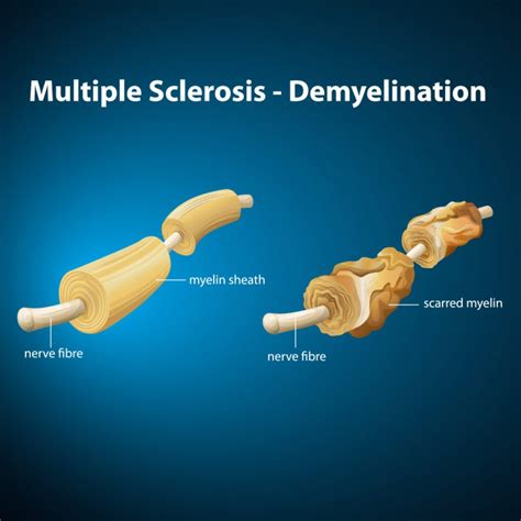 What is Multiple Sclerosis (MS) - MS Australia