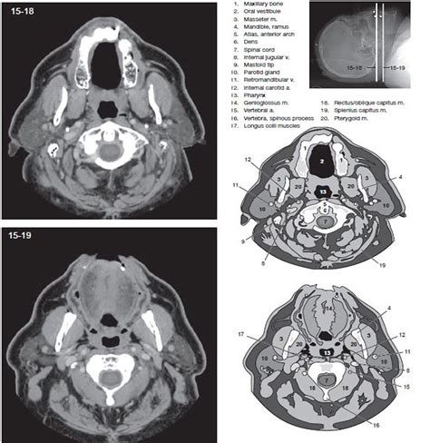 neck ct scan | Ct scan, Radiology, Head and neck