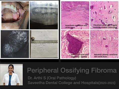 Peripheral Ossifying Fibroma Histology