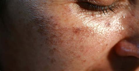 Skin Pigmentation & Hyperpigmentation: What It Is & How to Treat