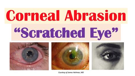 Corneal Abrasion (“Scratched Eye”) | Causes, Signs & Symptoms ...