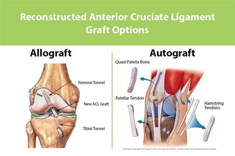 Choosing an ACL Graft - what is your best option? - Dr. Frank Petrigliano