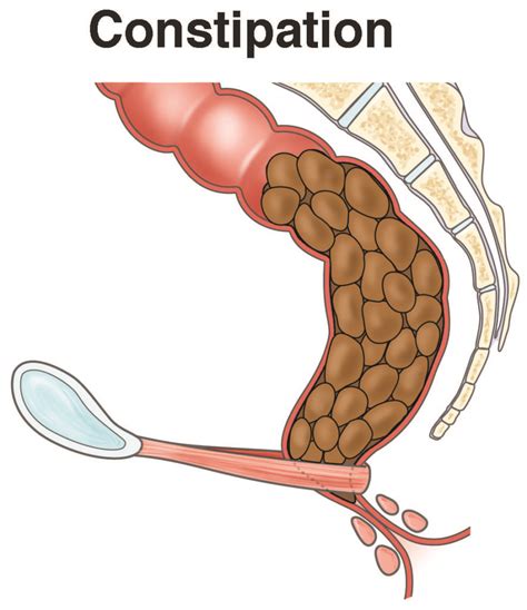 Constipation - AGA GI Patient Center