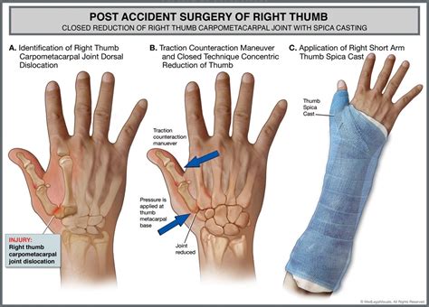 Closed Reduction | Dislocation, It cast, How to apply