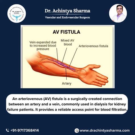 Understanding Fistula Surgery for Dialysis: Guiding Principles