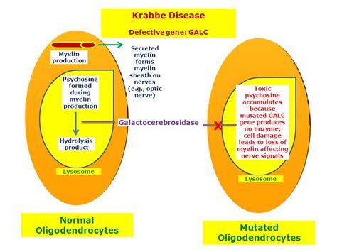 Krabbe Disease | Hereditary Ocular Diseases