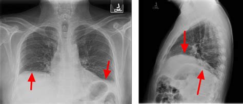 Atelectasis - Causes, Symptoms, Atelectasis Treatment