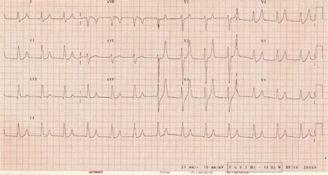 Hyperkalaemia Clinical Case • LITFL • Clinical case