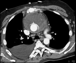 Hemopericardium Plus Mnediastinal Hematoma - Chest Case Studies ...