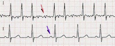 Atrial fibrillation - Wikipedia