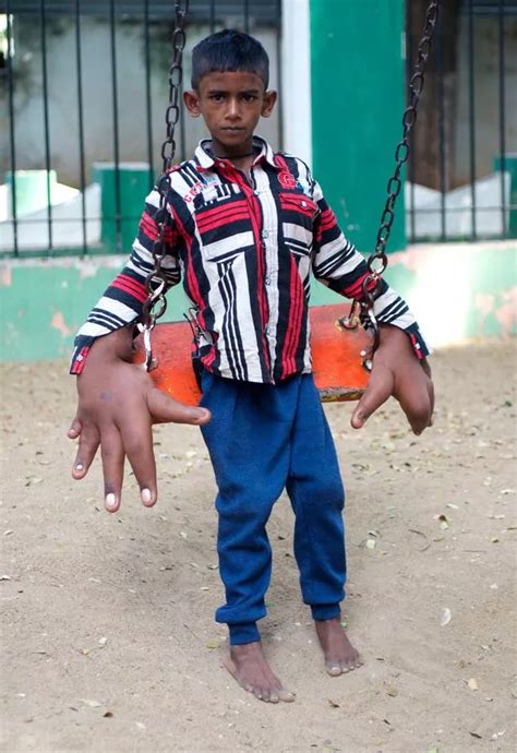 'Boy with the World's Biggest Hands' measuring 33cm has surgery to reduce their size - World ...