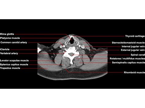 Ct Scan Neck Anatomy