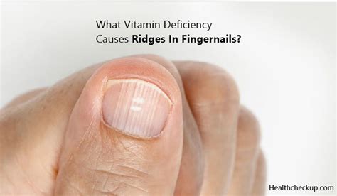 What Vitamins Deficiency Causes Ridges In Fingernails | Fingernails, Vitamins, Vitamin deficiency