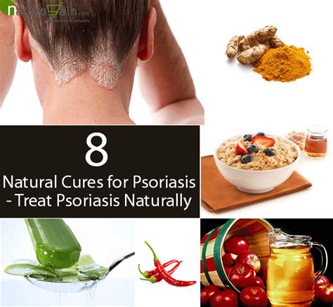 8 Powerful Natural Cures for Psoriasis - Treat Psoriasis Naturally