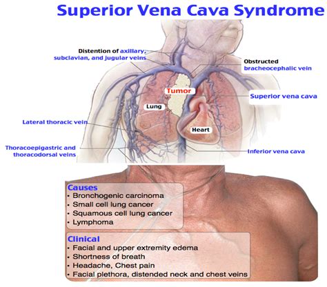 Superior Vena Cava Syndrome Anatomy