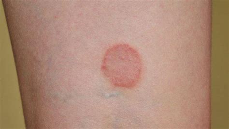 Dermatitis Numularis - TribunnewsWiki.com