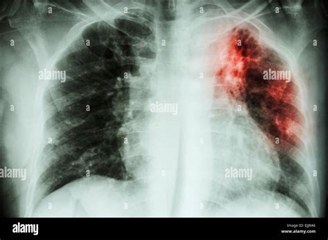 Pulmonary Tuberculosis . Chest X-ray : interstitial infiltration at Stock Photo: 80318734 - Alamy