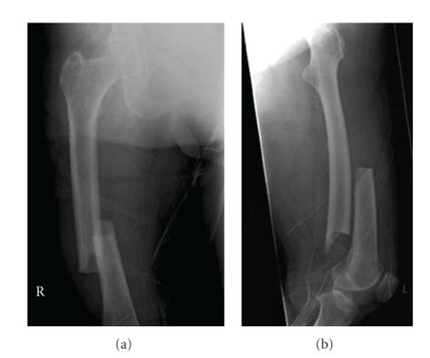 A case of bilateral femur fractures in a patient who had been on... | Download Scientific Diagram