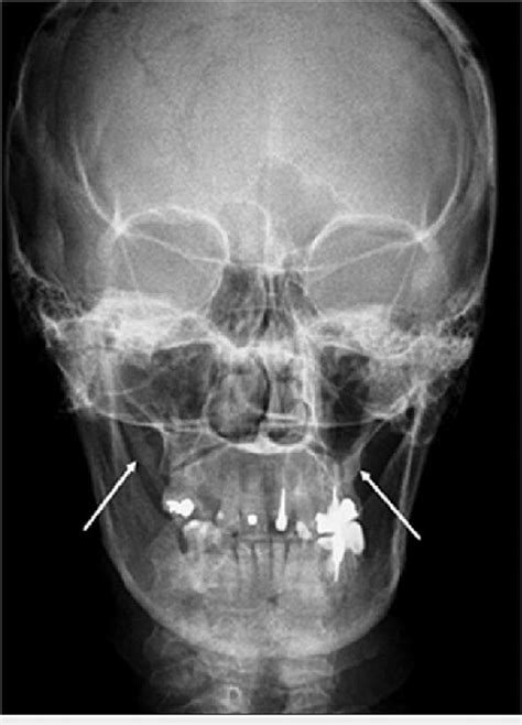 X-ray: reverse Towne's view showing the elongated styloid process of... | Download Scientific ...