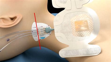 Application & Removal 3M™ PICC CVC Securement Device + Tegaderm™ CHG Dressing - YouTube